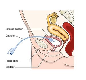 Female Suprapubic Catheter.jpg